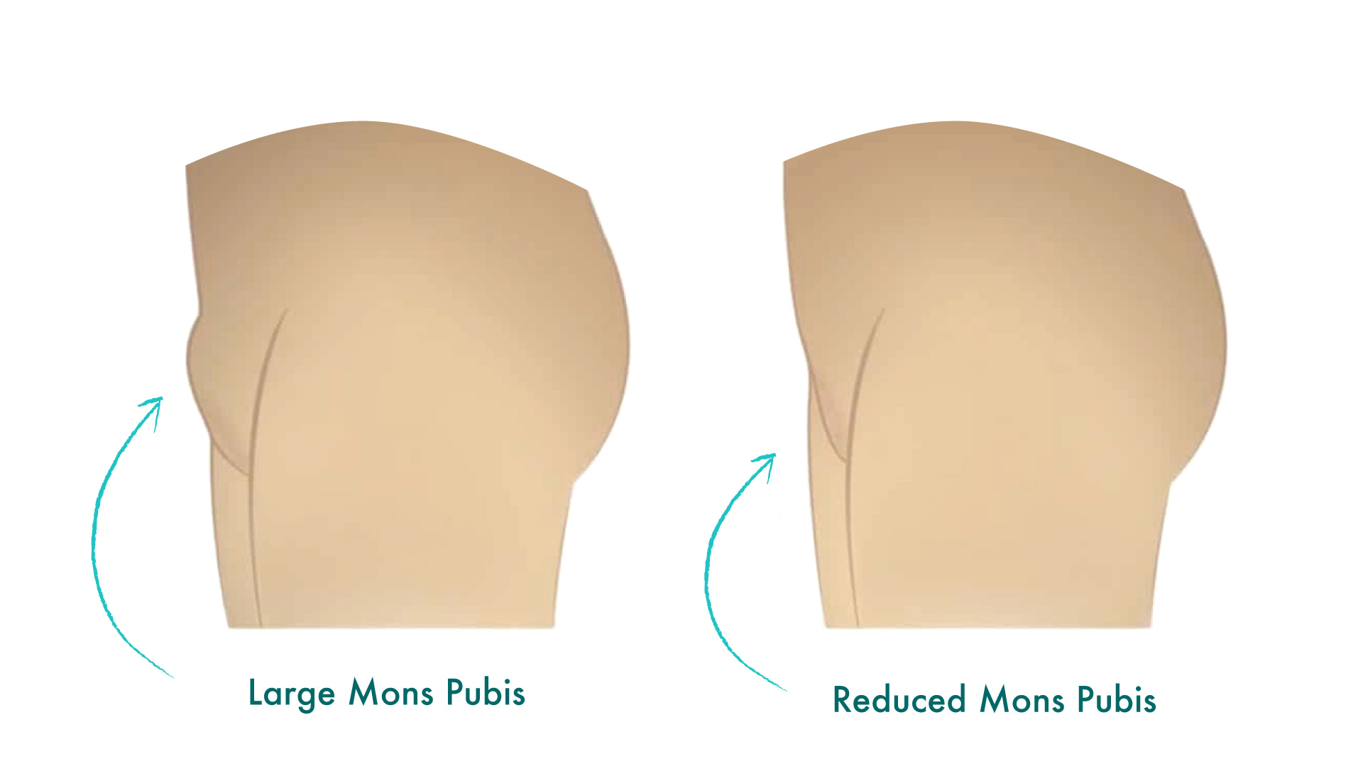 FUPA (Fatty Upper Pubic Areas)