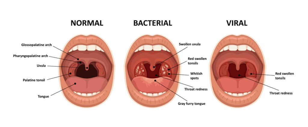 sore throat on one side